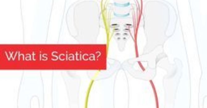 What is Sciatica? image