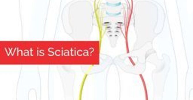 What is Sciatica? image